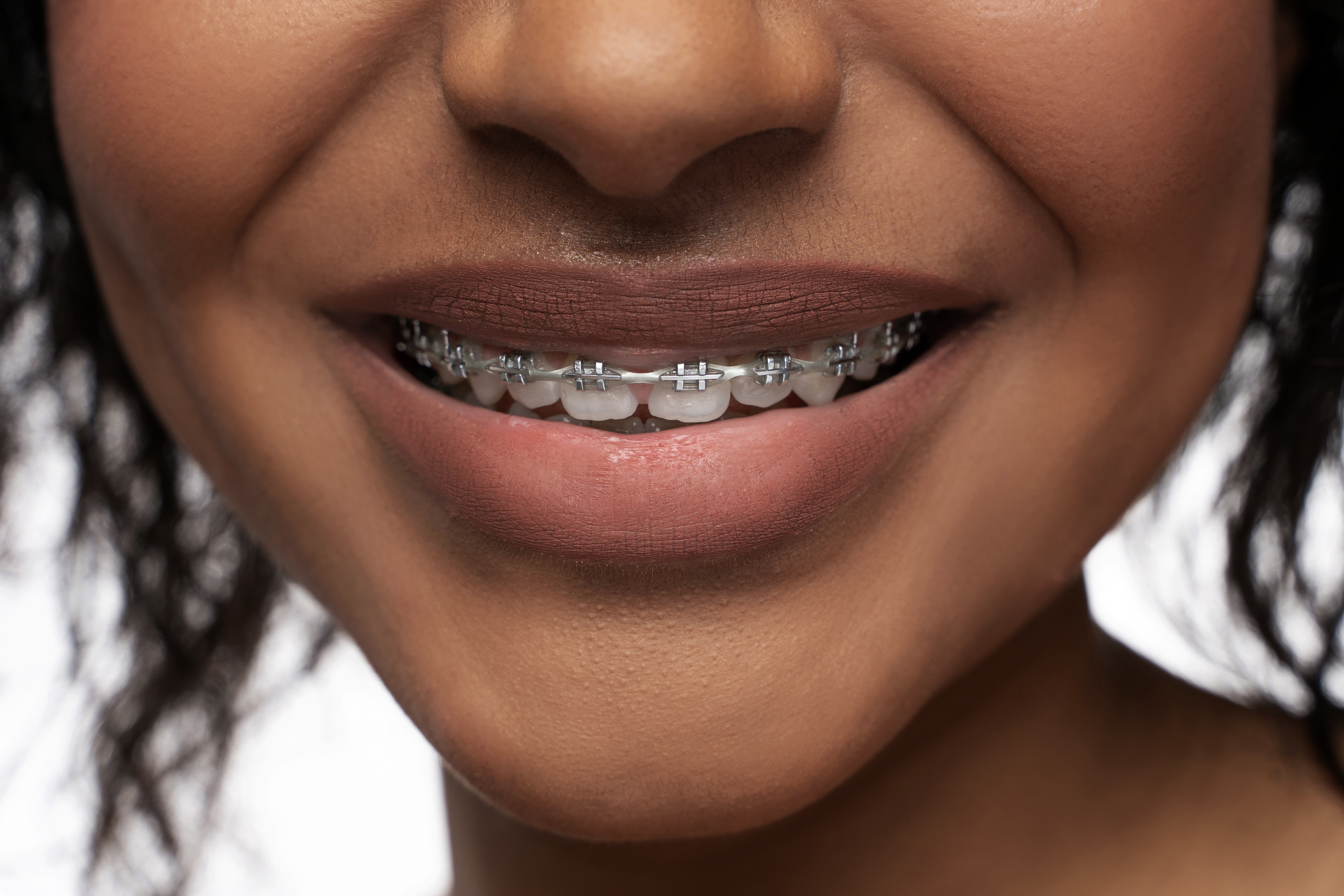 Closeup of black woman's smile with a dental braces on teeth